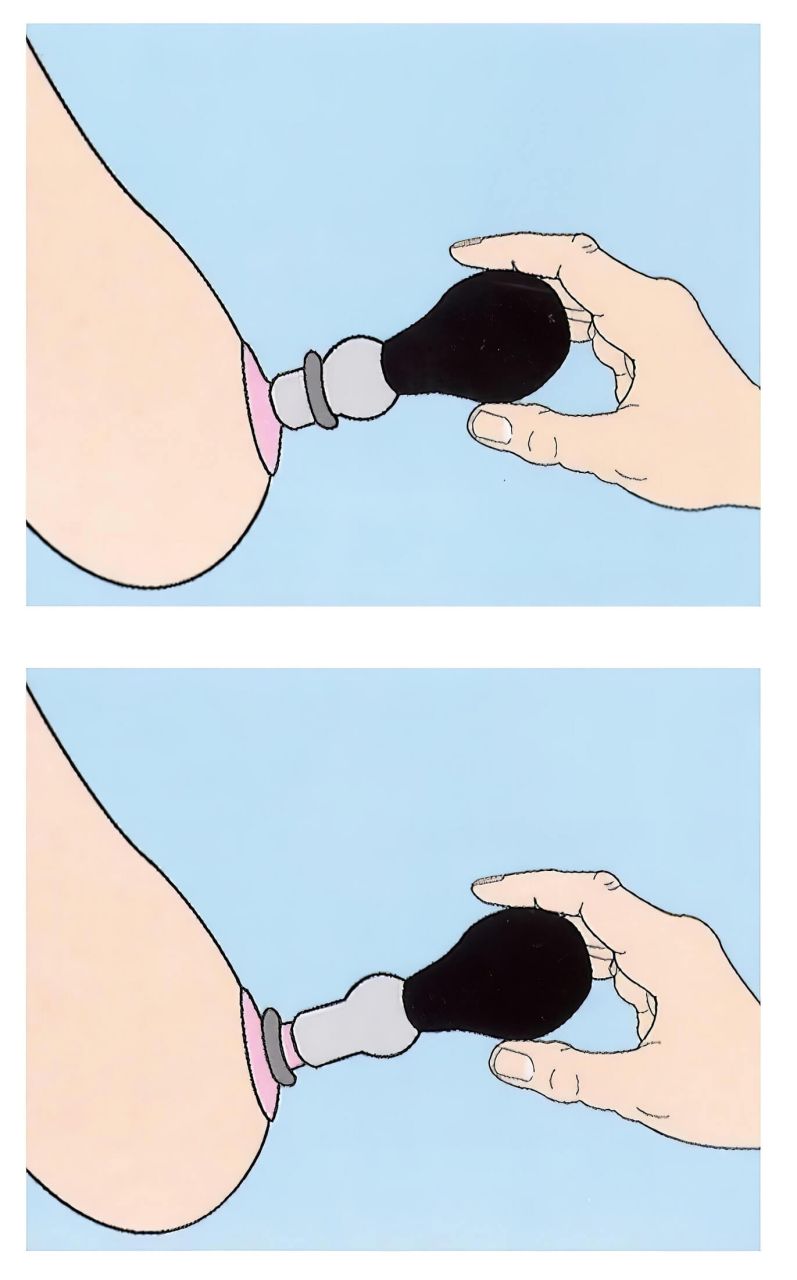 Mellbimbó pumpa szett (2db) Mellbimbó pumpa szett (2db)